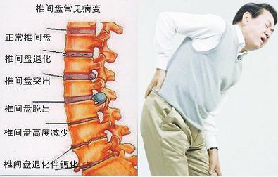 腰肌劳损常见的发病人群